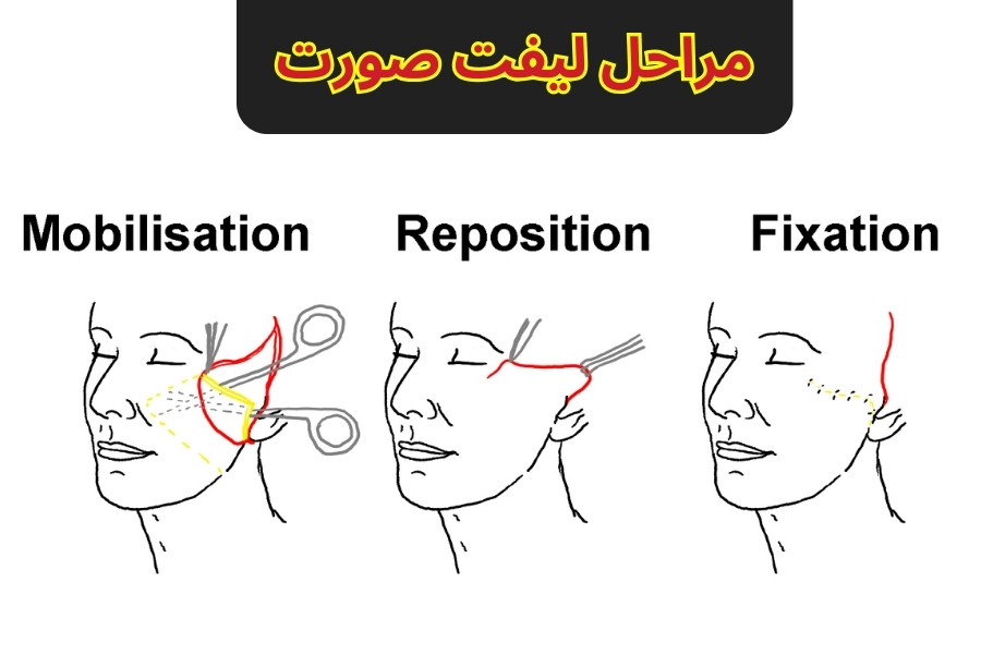 مراحل لیفت صورت
