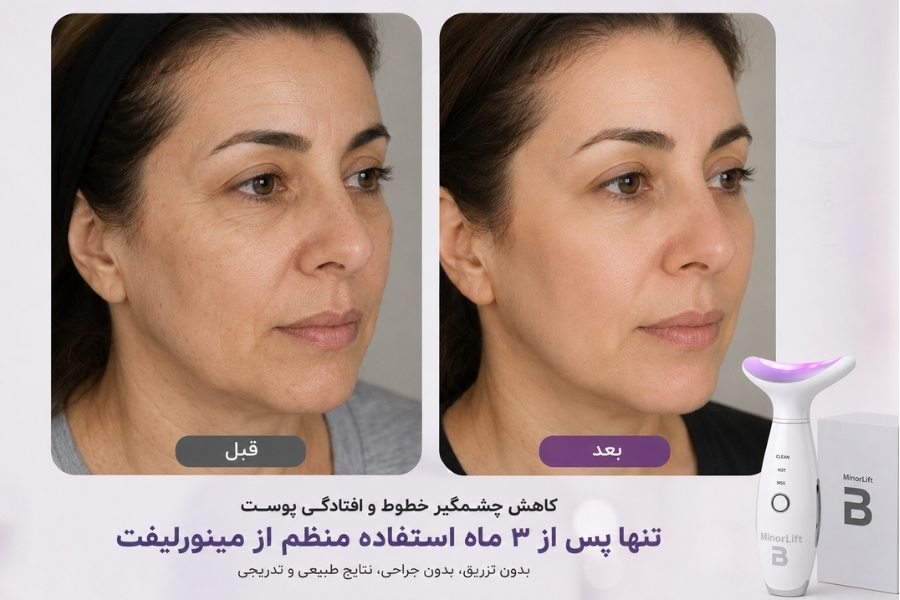 جدیدترین دستگاه لیفتینگ صورت