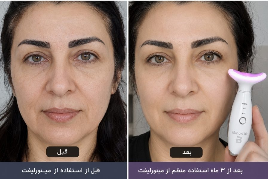 جدیدترین دستگاه لیفتینگ صورت