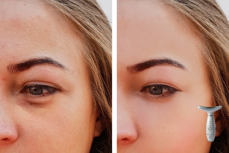 Removing puffiness and darkness under the eyes