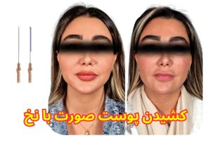 کشیدن پوست صورت با نخ