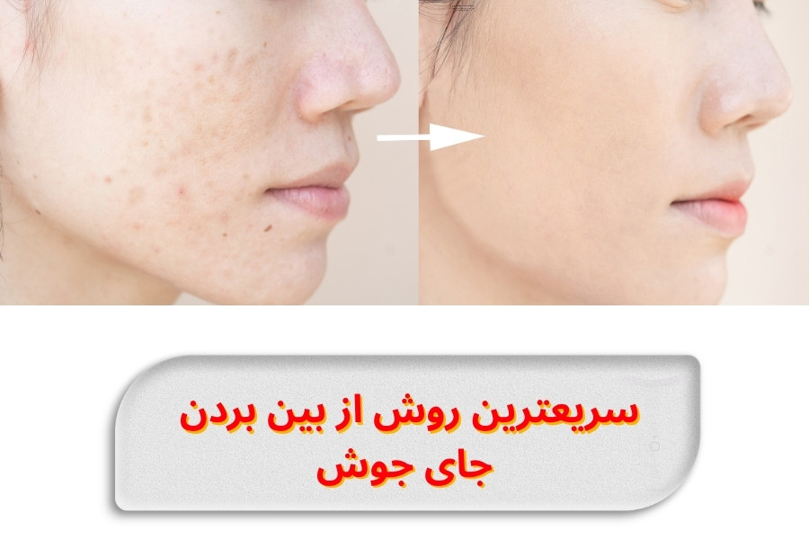fastest-acne-scar-removal-methods-guide